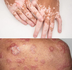 কুষ্ঠরোগ ও ধবল কি বুধবার দিনে বা রাতেই শুরু হয়?